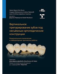 Вертикальное препарирование зубов под несъемные ортопедические конструкции