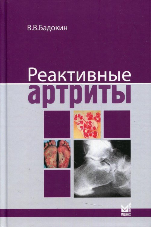 Реактивные артриты