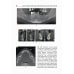 Костная пластика перед дентальной имплантацией. Учебное пособие