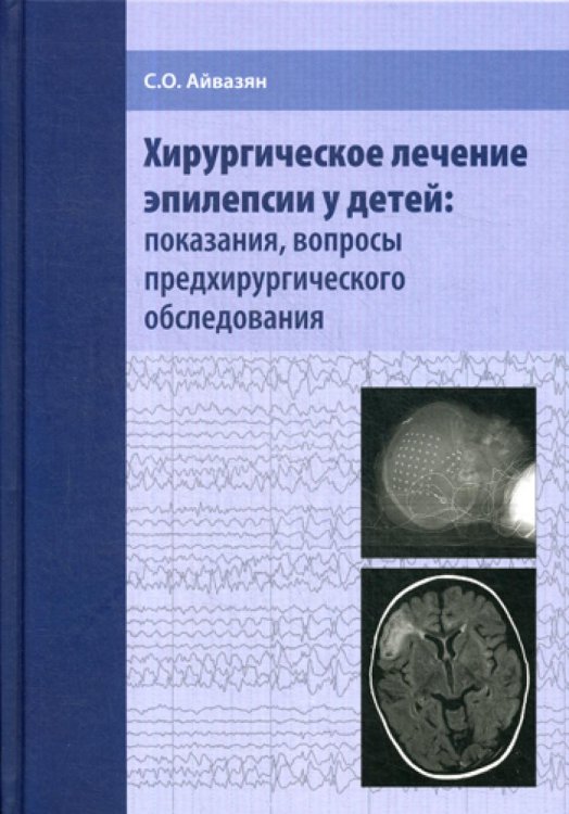 Хирургическое лечение эпилепсии у детей: показания, вопросы предхирургического обследования / 