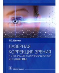 Лазерная коррекция зрения и этот загадочный инновационный метод ReLEx SMILE